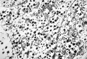 F,44y. | carcinoid - lung